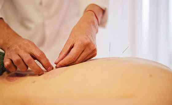 Иглоукалывание в Москве китайскими врачами цена Москва