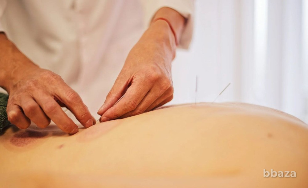 Иглоукалывание в Москве китайскими врачами цена Москва - изображение 1